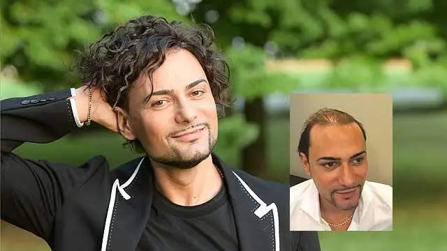 CRLAB CNC Men's Hair Replacement Detroit MI