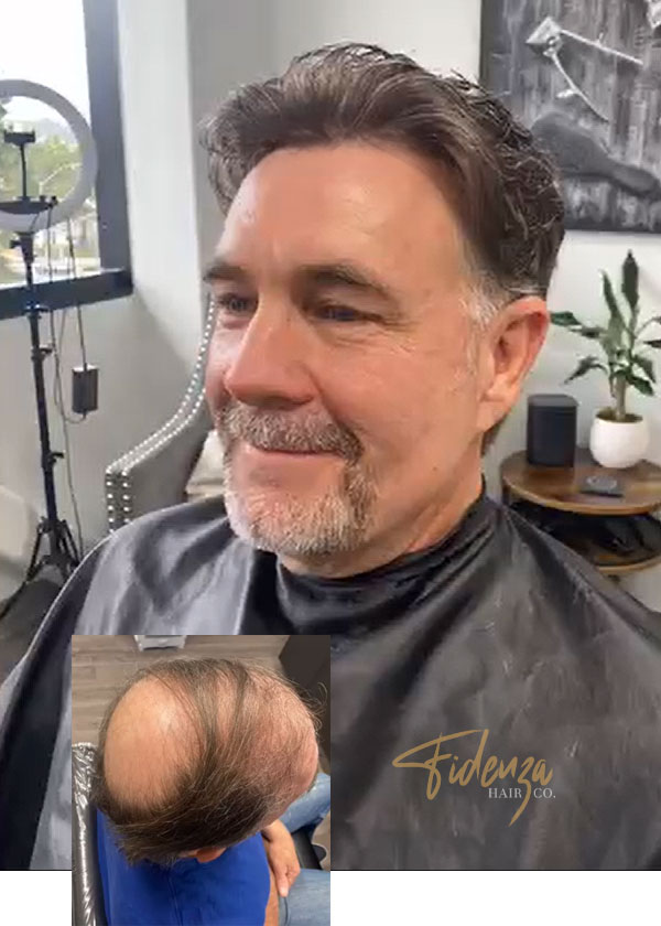 mens hair replacement la jolla california lifestyle fidenza