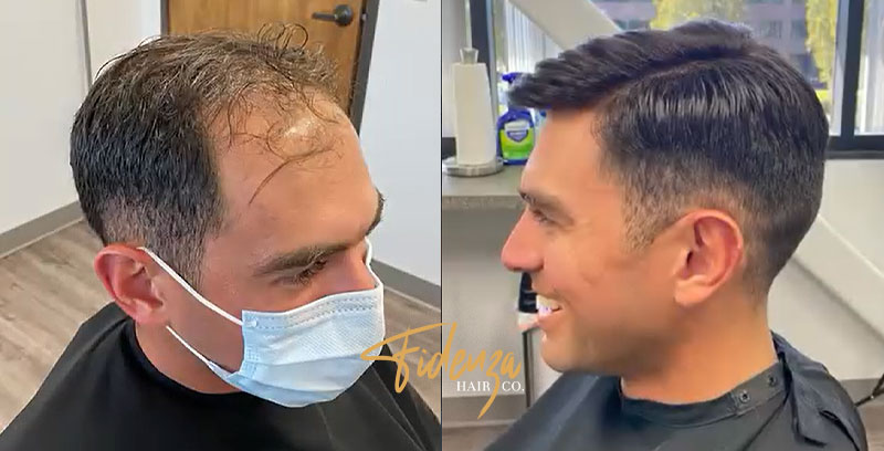 mens non-surgical hair replacement la jolla ca - fidenza hair co