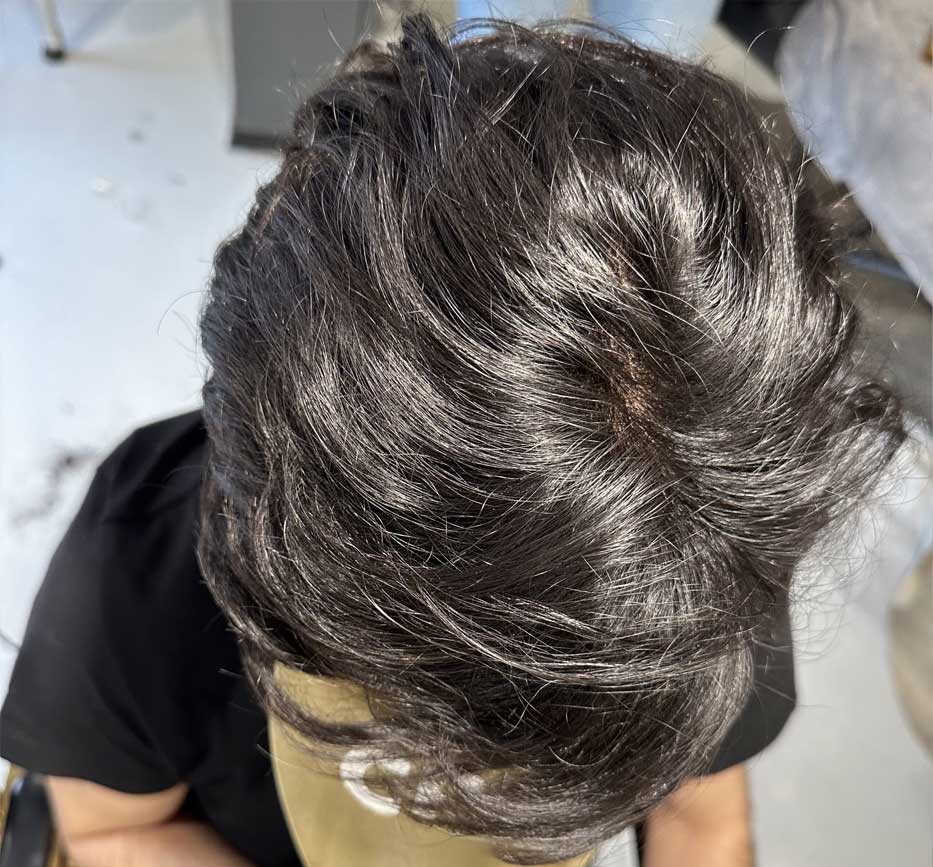 trichology hair loss treatment San Diego